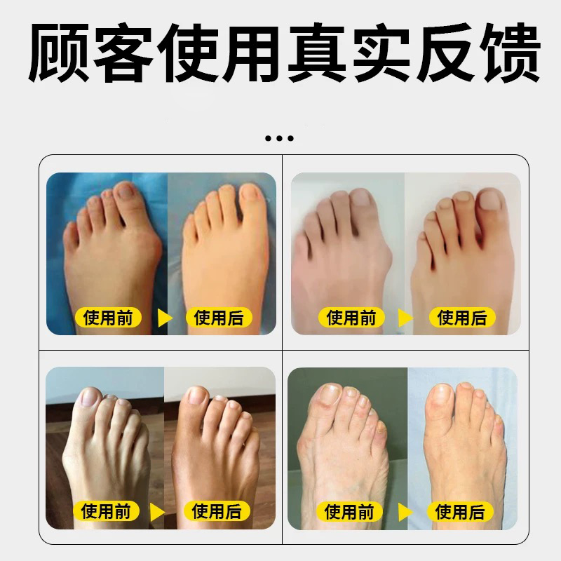 儿童外翻矫正器分离可穿鞋拇指大母脚趾分趾固定神器大脚骨拉力带 - 图3