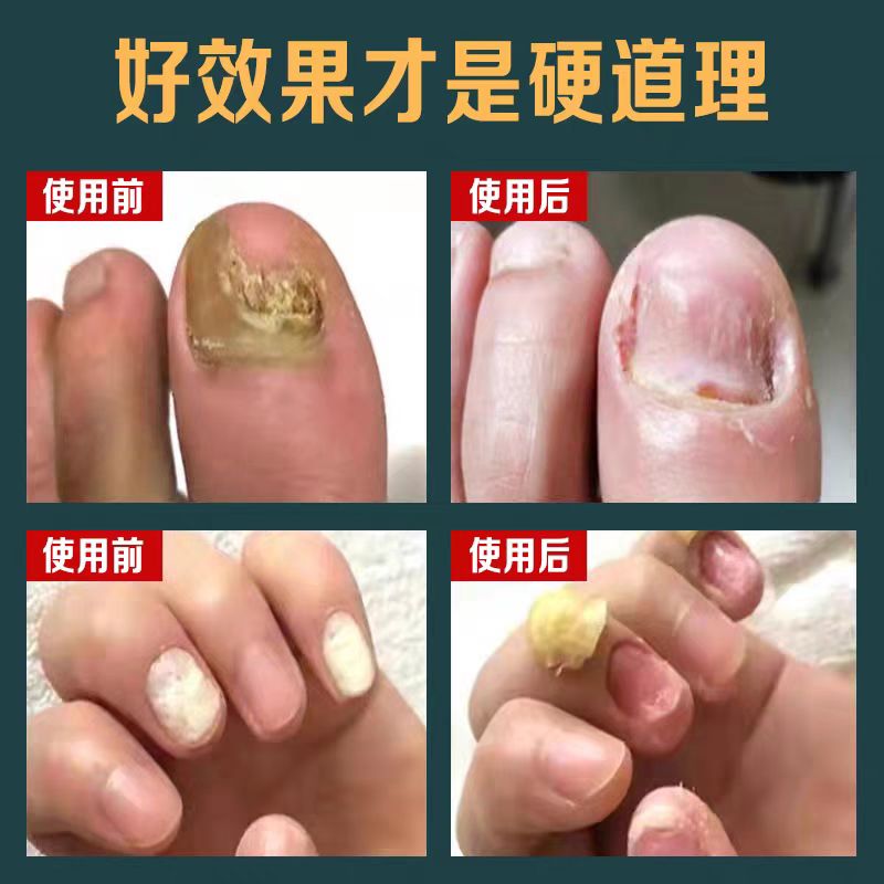 灰指甲脱甲膏专用抑菌液甲沟炎灰趾指甲快速脱甲精油脚指甲软化剂 - 图0