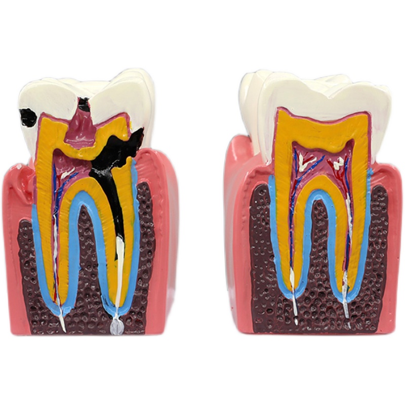 牙科口腔诊所龋齿蛀牙病理牙解剖模型牙齿模型刷牙教学模型幼儿园 - 图3