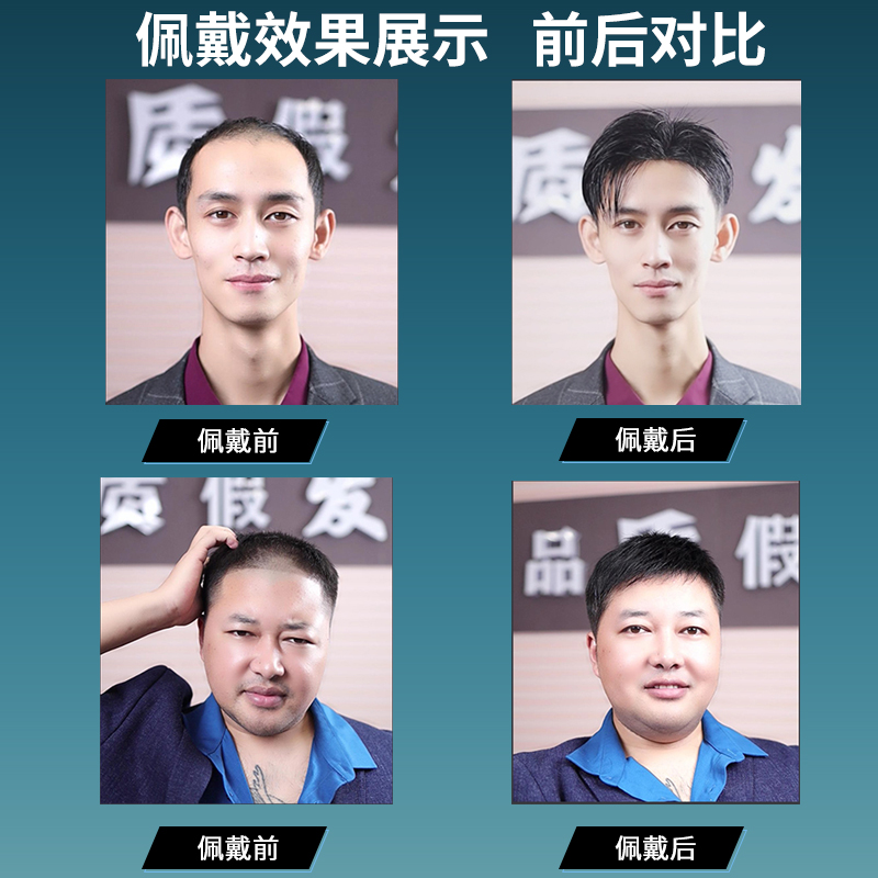 假发男生头顶真发织发块碎盖短发发际线增发量刘海补发片帅气无痕 - 图2