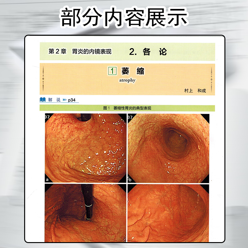 正版 京都胃炎分类 内镜诊断图谱 慢性胃炎书籍 消化内科书籍 胃病书籍 胃肠书籍 消化内镜书籍 萎缩性胃炎书籍辽宁科学技术出版社 - 图3