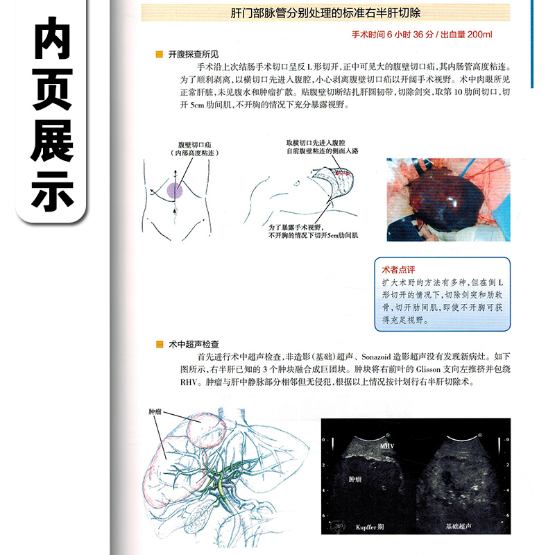 正版 肝胆胰外科手术实录 主译唐伟 东京大学医学部 人工脏器移植外科手术操作图谱教程 人民卫生出版社9787117288170 - 图2