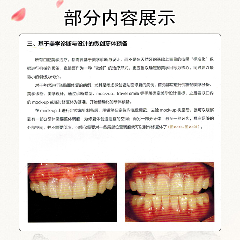 正版 瓷贴面修复技术 从标准到微创无预备 口腔美学修复学参考工具书籍 口腔诊所瓷贴面修复教程 人民卫生出版社9787117237499 - 图3