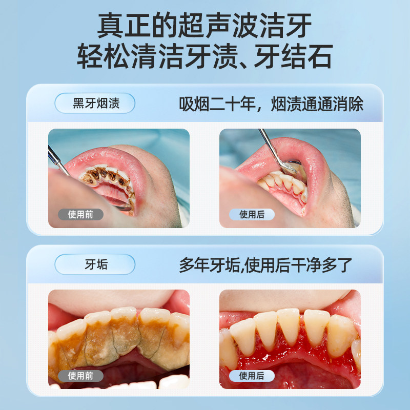 牙结石去除器超声波清洁洗牙机 汇优尚品其它口腔护理设备