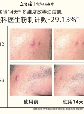 水杨酸祛痘清洁毛孔闭口粉刺舒缓