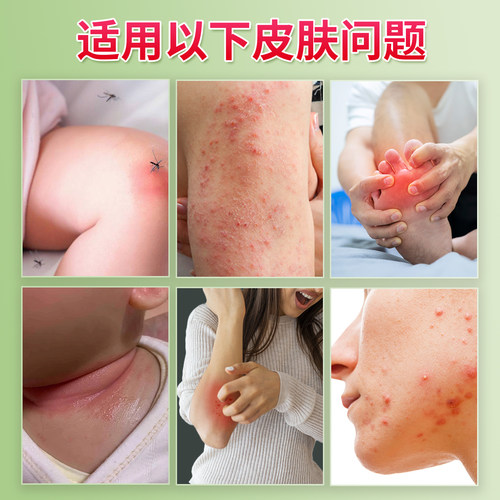 苗仁堂苗灵肤必舒皮肤瘙私处湿痒牛癣清苗一手疹肿红皮大腿内侧炎 - 图1