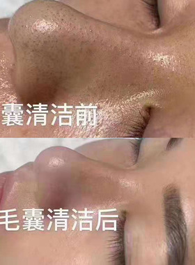 美容院毛囊清洁霜面部护理