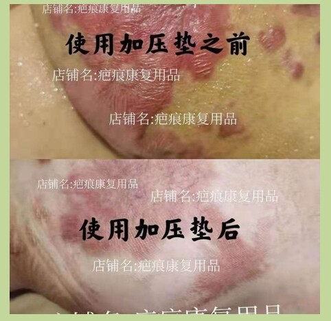 弹力套疤痕加压垫硅胶垫压力垫疤痕增生压力套烧烫伤术后疤痕贴 - 图1