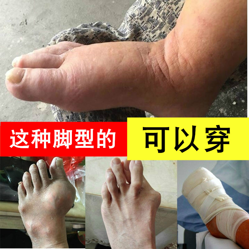 糖尿病足鞋中老年人脚肿加肥加宽浮肿男拇外翻女大脚骨宽松鞋春夏-图0