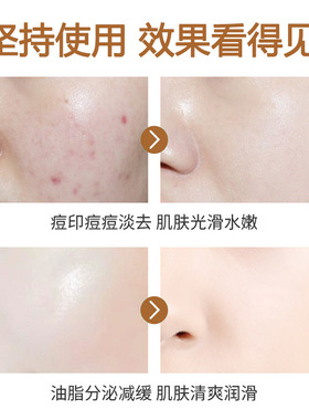 倾龄立体水杨酸凝胶粉刺淡化痘印去黑头水杨酸清洁软膏男款女