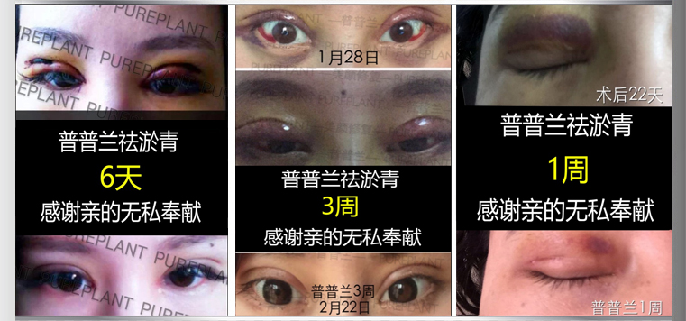 1059043 淘宝正品店铺号 普普兰精油小银瓶术后快速恢复 1059043 淘宝正品店铺号 普普兰精油小银瓶术后快速恢复