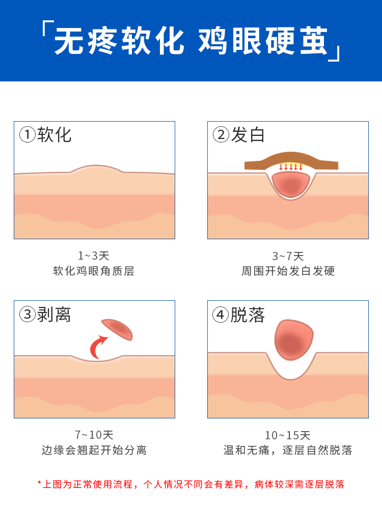 去鸡眼膏脚鸡眼贴神器脚底肉刺去除膏疣灵瘊子手部趾疣膏足部根-图1