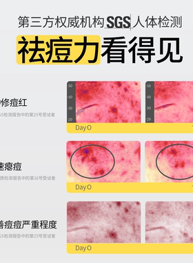羽素闭口湿敷水祛痘淡印修护套组