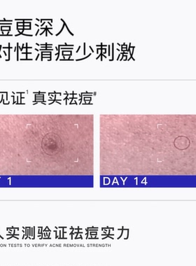 净痘控油】毛囊净祛痘精华液控油补水淡化痘印舒缓毛孔祛痘精华液