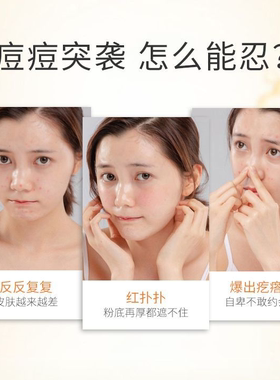 日本花印痘痘凝露进口正品