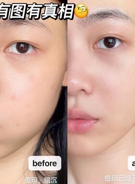 贝玲美377美白精华液淡斑改善暗沉提亮肤色暗黄干皮混油皮补水