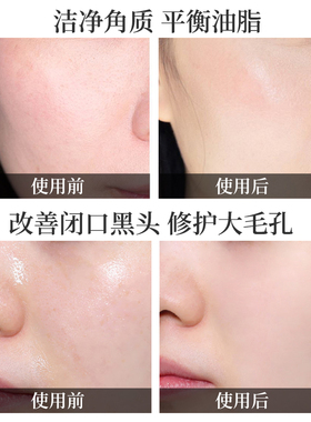 【官方授权】薇诺娜果酸刷酸套装复合酸水杨酸黑头痘修复痘印
