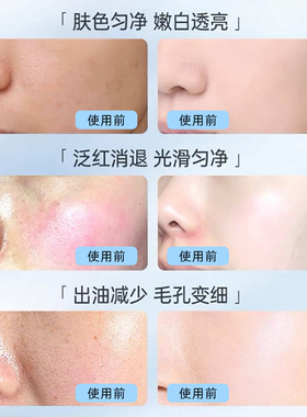 博乐达水杨酸源码高浓度源码滋养保湿面膜闭口粉刺黑头30%高酸