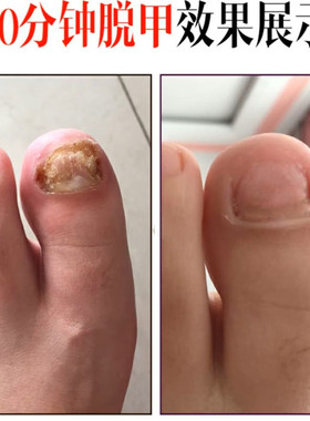 脱甲液专用药水正品去除