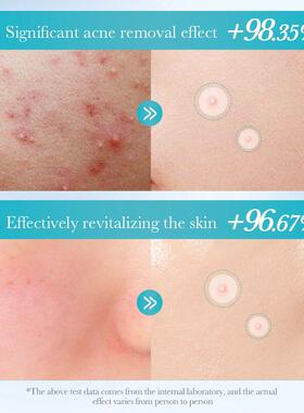 水杨酸痘贴 Salicylic acid cleansing acne patch revitalizing
