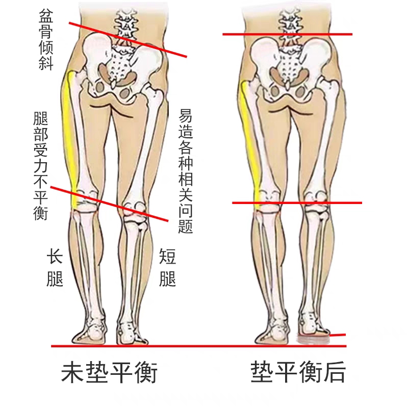 长短腿增高矫正鞋垫高低脚补高调节防盆骨倾斜脊柱校正下肢不等长 - 图0