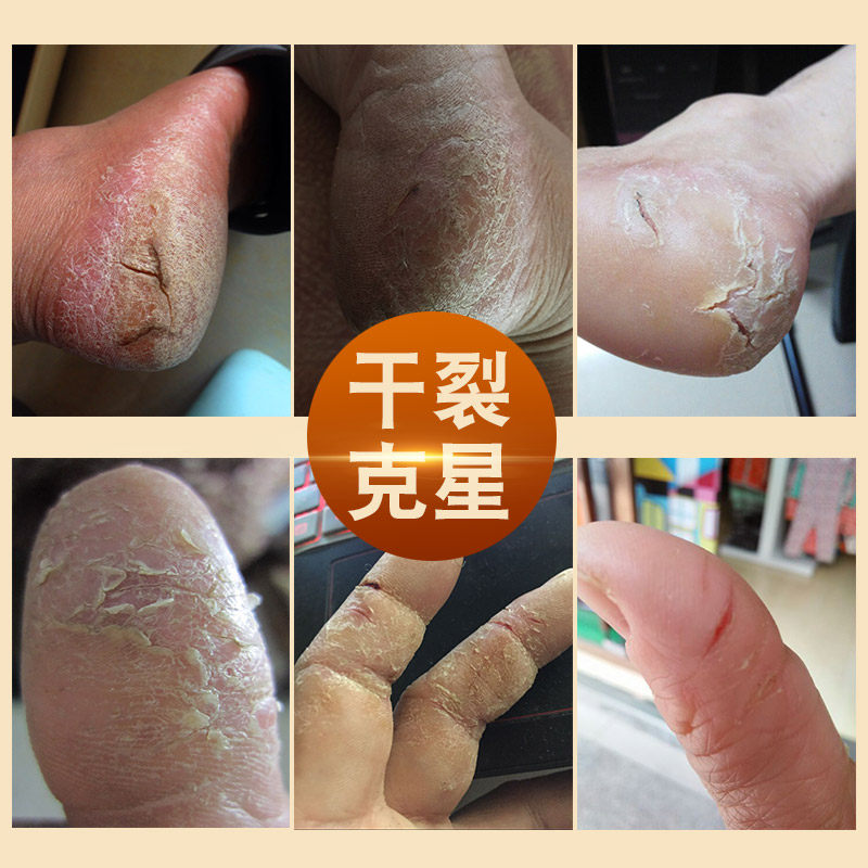 脚后跟干裂手足防裂皲裂手脚跟膏 金泰康铃医护手霜