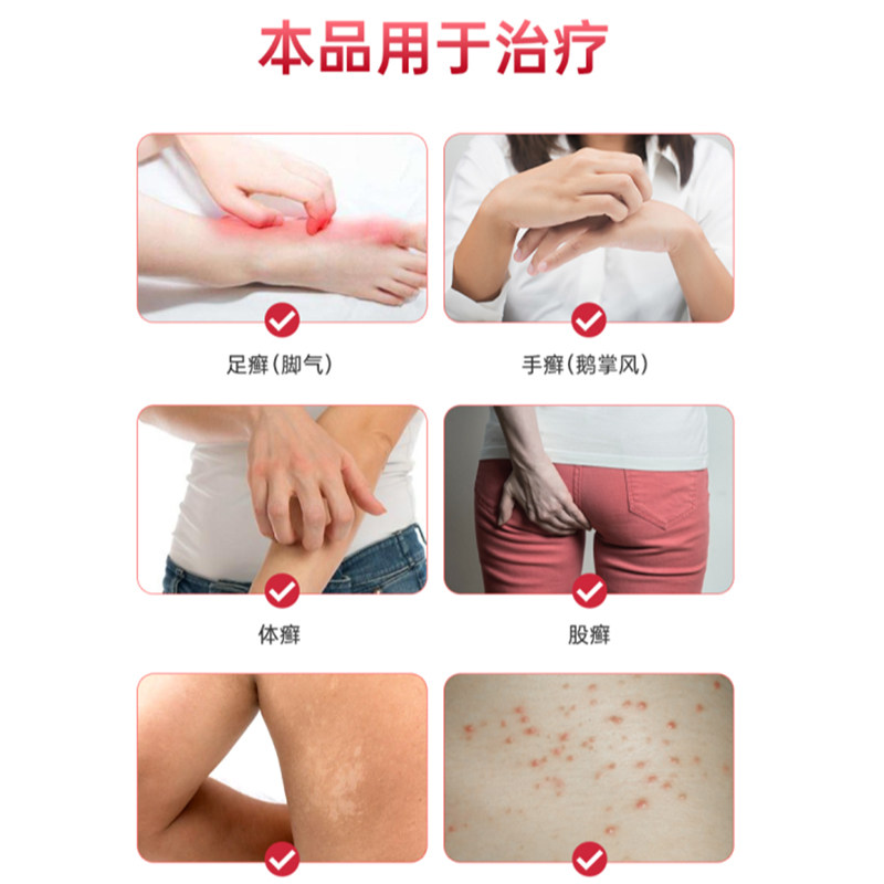  德开大药房旗舰癣症