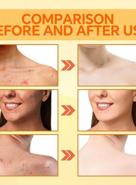 Kojic acid soap brightens skin tone, exfoliates and deeply c