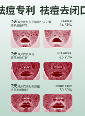 童颜纪皮傲宁祛痘修护套装