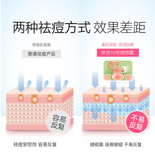 香港正品曼秀雷敦OXY快治暗疮膏祛痘膏祛痘印快治5号25g快治10号 - 图1
