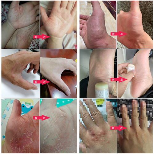 吉夫宝小蓝盒去除出汗多季节性反复手指缝硬泡脱皮干裂原汗疱宁霜 - 图1
