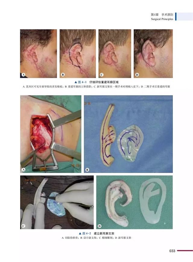 耳再造术 原书第2版 Juarez M. Avelar 主编 薛峰 蔡震 主译 中国科学技术出版社 9787523600849 医学卫生书籍 - 图2