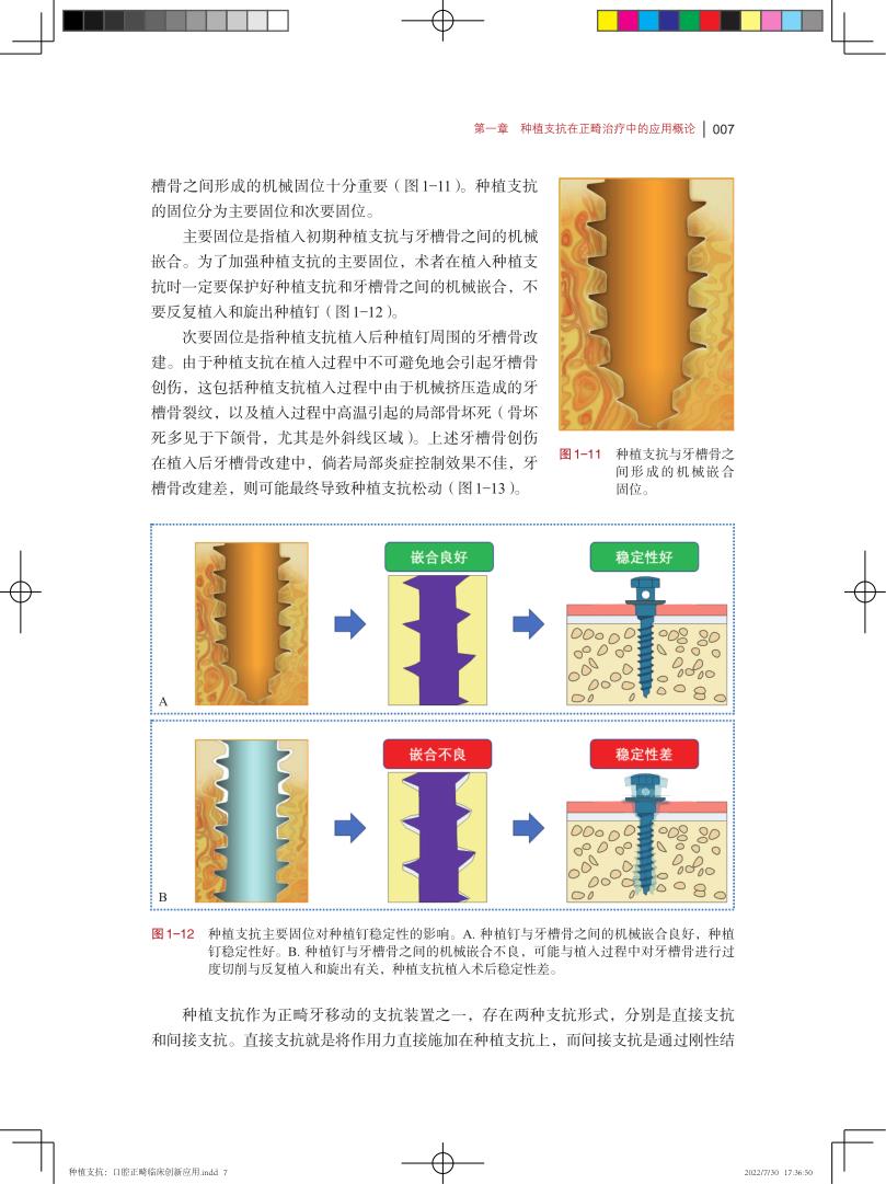 种植支抗在正畸治疗中的创新应用 临床口腔科学 图文并茂阐述种植支抗植入步骤和植入技巧的专著 龙虎 韩向龙 上海科学技术出版社 - 图1