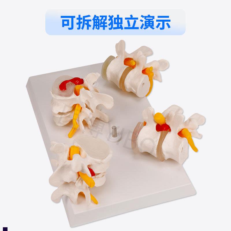 医博BIX-A3561人体腰椎间盘突出病变演示模型人体脊柱腰椎模型人O - 图2