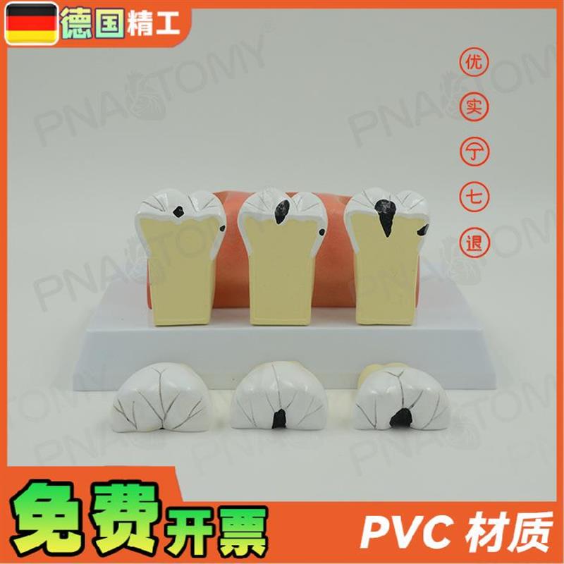 德国】牙科牙g齿龋齿解剖分解模型口腔科牙科病理蛀牙模型 教学展 - 图2