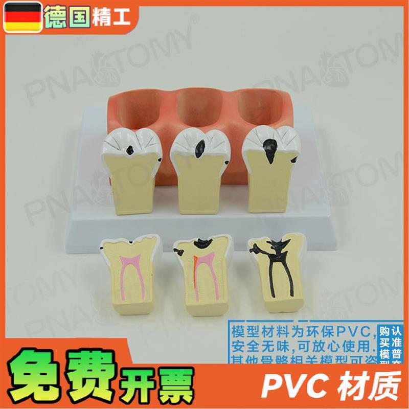 德国】牙科牙g齿龋齿解剖分解模型口腔科牙科病理蛀牙模型 教学展 - 图1