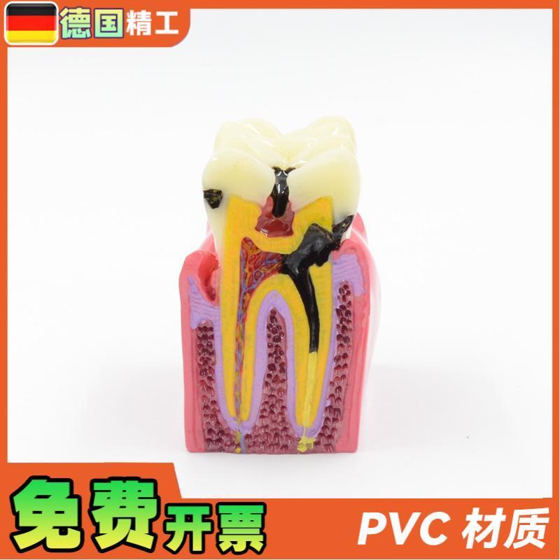 德国】六倍龋齿对比模q型口腔牙齿模型口腔教学蛀牙切面模型牙 - 图0