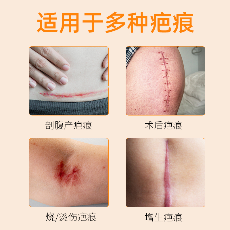 杨四郎药业剖腹产术后疤痕膏贴烫伤摔伤疤医用疤痕硅酮凝胶伤疤膏