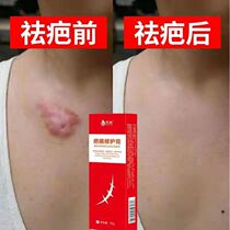 Net red Scar Repair J No Paste Scar) Men and women Go scar Hand Medical scar Old scar Scar Old Scar a pack