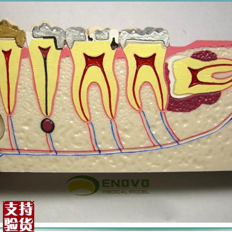 ENOVO颐诺右下后牙组织分解模型牙G齿解剖牙列模型口腔齿科科教学 - 图0