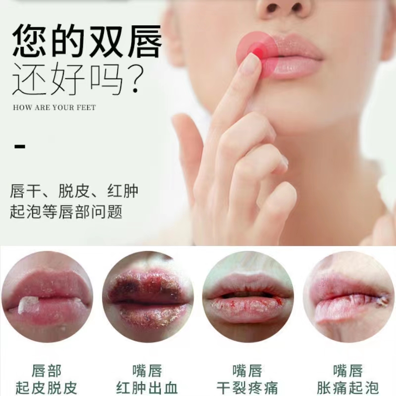 3支44】正品芮森药莊唇部型润唇膏口角炎唇膏软膏烂嘴角口周皮