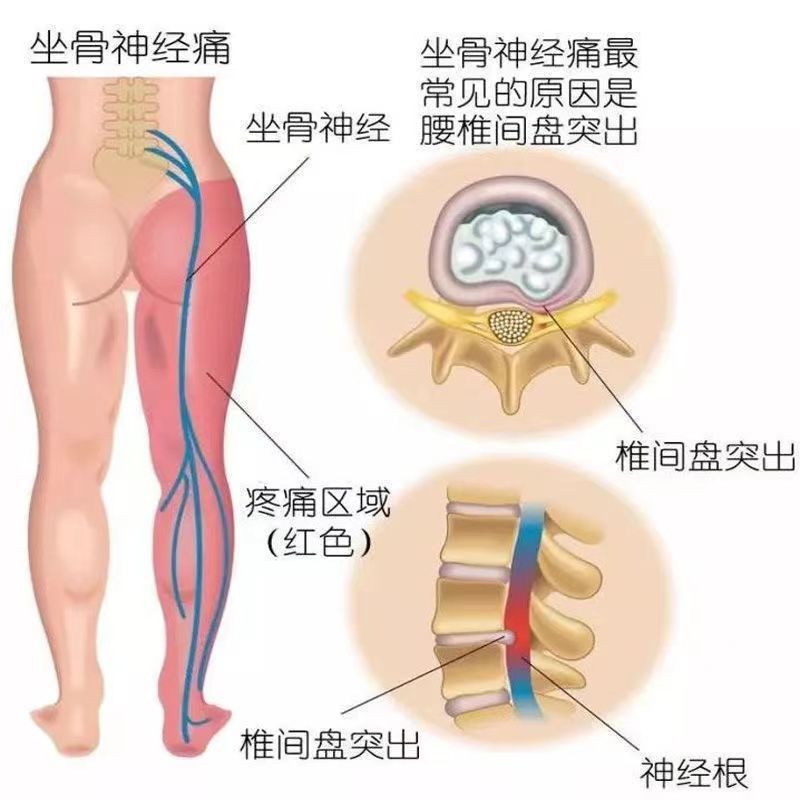 坐骨神经疼贴膏腰间盘突出专用腰椎压迫神经腿屁股疼痛通络膏药贴 - 图3