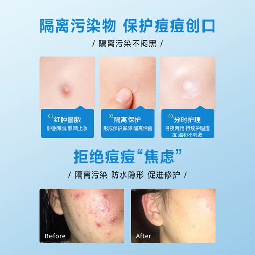 Медицинский пластырь от прыщей, невидимый лейкопластырь, наклейки, тональный крем, скрывает прыщи