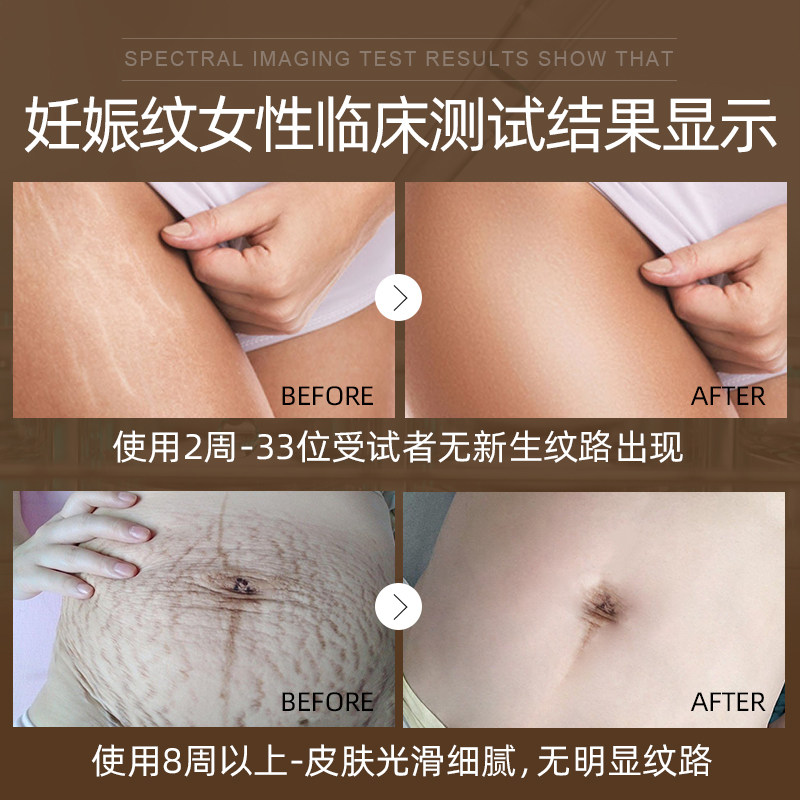防妊娠纹去橄榄油孕妇妊娠纹修复霜 SugarBunny海外妊娠纹护理