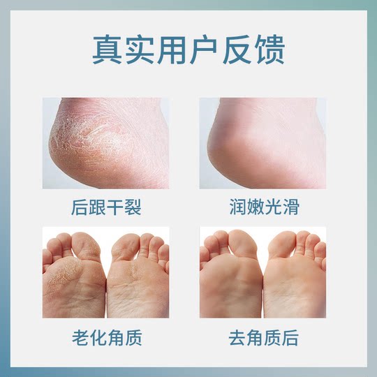 XIX foot heel calluses dead skin softener tool tool pedicure knife rough men and women