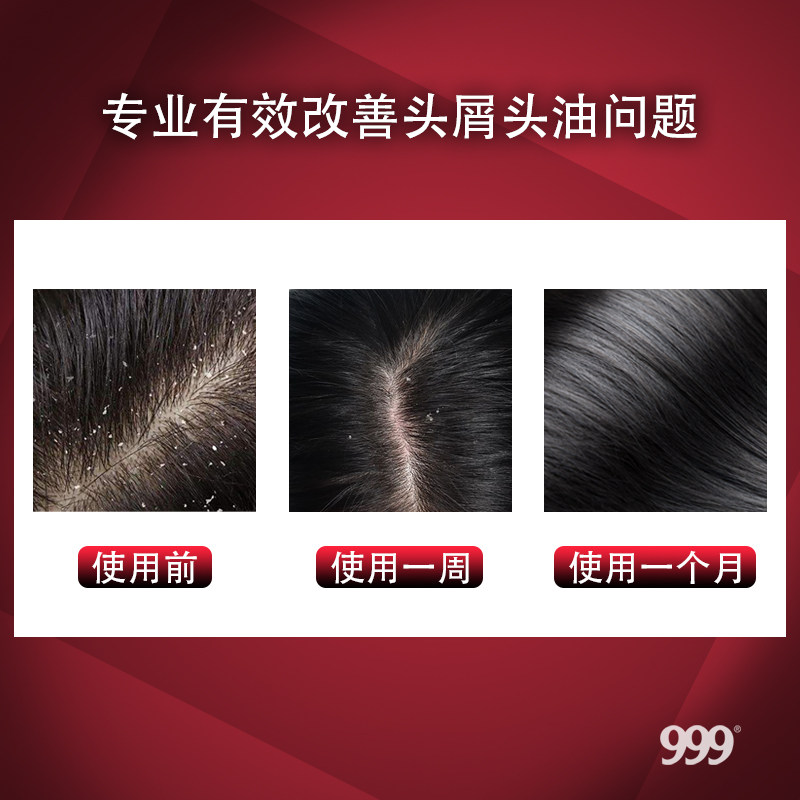 999漾选去屑控油蓬松脂溢性洗发乳 999洗发水