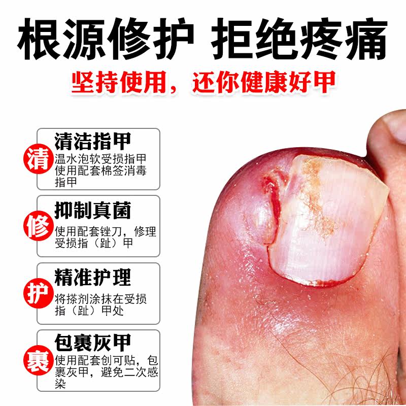 灰指甲抑菌液正品30灰指甲专用药 欣梵医疗器械保健理疗