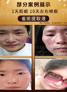 提取液点斑水点状斑雀斑