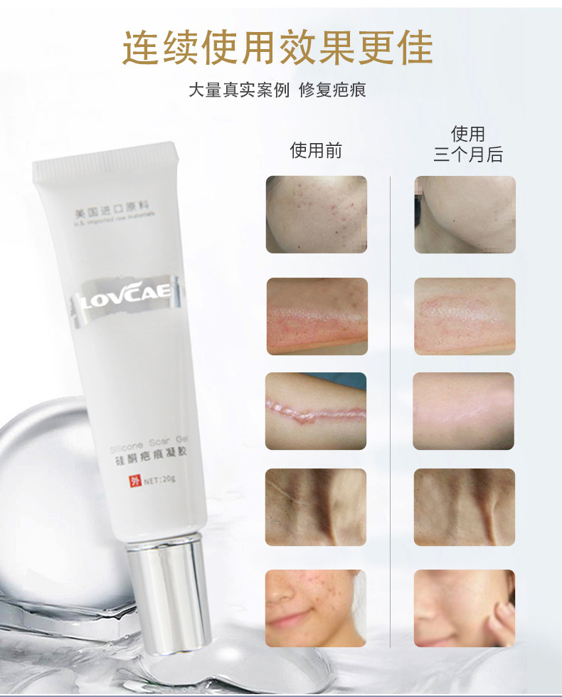 医用硅酮凝胶手术修复疤痕祛疤膏 曦宏医疗器械祛疤产品