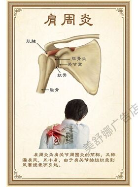 关节炎 人体关节 腰椎管狭窄症 肩周炎 颈椎病海报广告美容院挂图